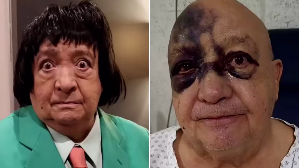 El comediante Luis de Alba fue hospitalizado, ¿qué le dejó el rostro morado?