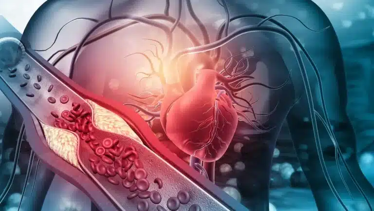 Estudio revela alta presencia de microplásticos en el corazón de pacientes con infarto